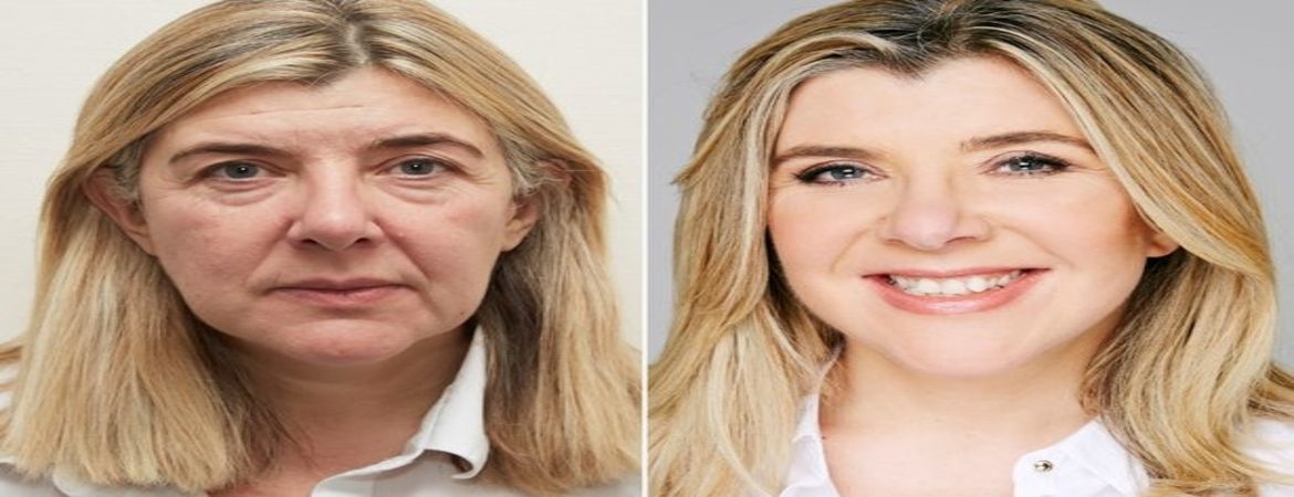 facelift-surgery