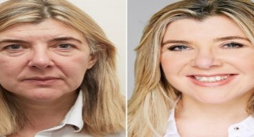 facelift-surgery