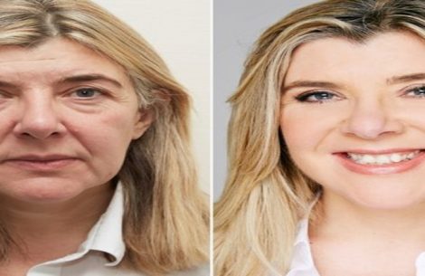 facelift-surgery