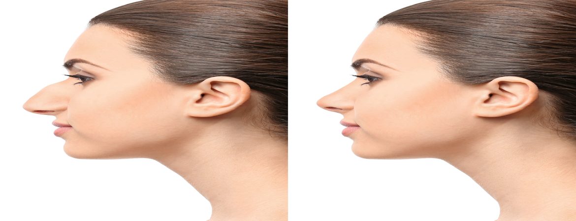 All you need to know about Rhinoplasty