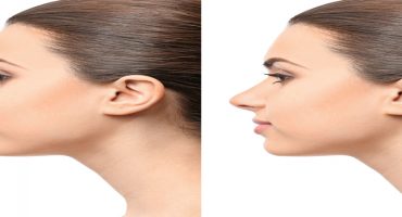all-you-need-to-know-about-rhinoplasty